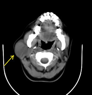 First Branchial Cleft Cyst-CT - Sumer's Radiology Blog