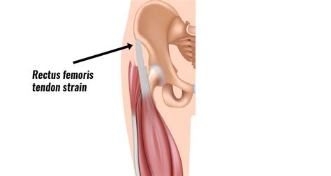 Rectus Femoris Tendon Strain - Symptoms, Causes, Treatment & Rehab