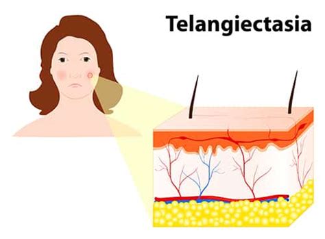 Telangiectasias Treatment