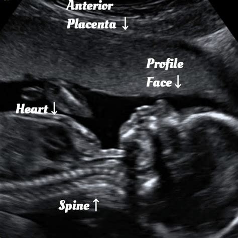 Guide for your normal 17 week Ultrasound. - Ultrasoundfeminsider