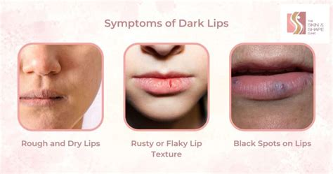 Dark Lips Treatment by Dermatologist - The Skin & Shape