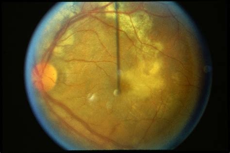 Serpiginous Choroiditis - Retina Image Bank