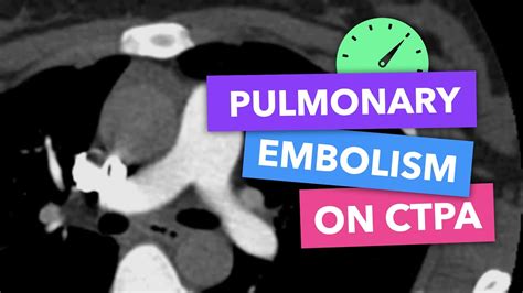 Pulmonary embolism on CTPA - Radiopaedia's Emergency Radiology Course - YouTube