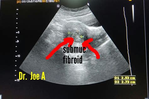 Ultrasound imaging: Submucosal-fibroid-vascular