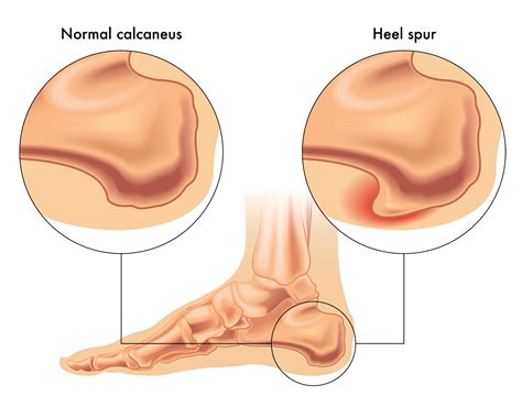 Physical Therapy for Bone Spurs | Heel Spurs