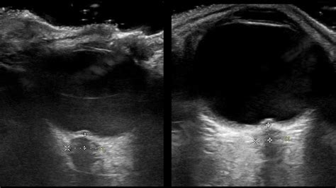 Optic nerve sheath diameter, Papilledema Ultrasound. Pseudotumor ...