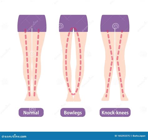 Arthritis Types Infographic Vector Illustration | CartoonDealer.com ...