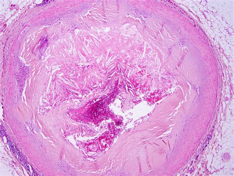 Atherosclerosis Plaque Specimen