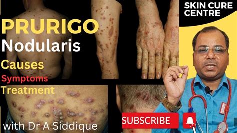 Understanding Prurigo Nodularis: Causes, Symptoms, and Treatment - YouTube