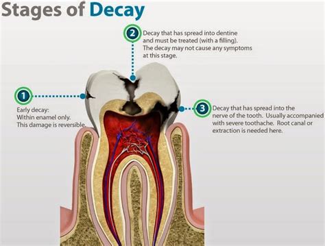 Omni Dental Group: Dentin Decay