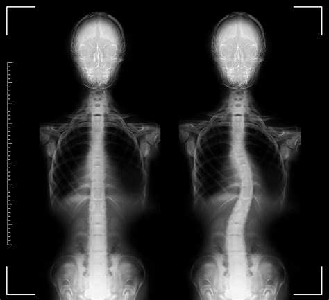 X-rays of human normal and curved spines. Patient suffering from ...