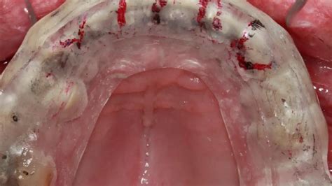 Different types of occlusal splints and their uses