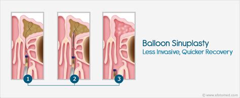 Balloon Sinuplasty - Less invasive, Quicker recovery