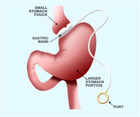 Laparoscopic Adjustable Gastric Band | 360 Bariatrics: Re-Shaping Bodies & Lives