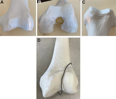 (A) Normal trochlear morphology, as represented on a 3D printed model ...