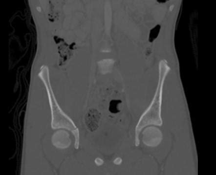 Pelvic Fracture X Ray