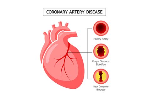 Coronary Artery Disease Symptoms