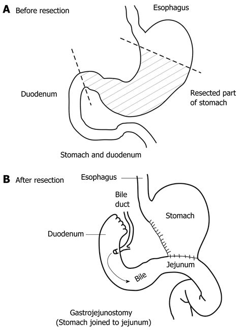 Billroth 2 Anatomy