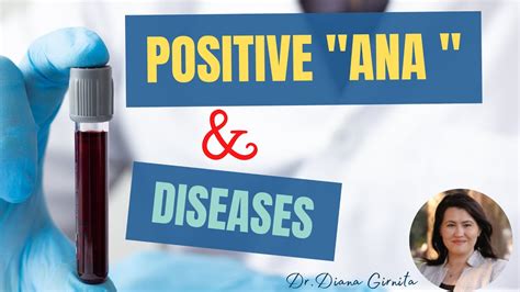 Positive ANA -Know Common 5 causes for a positive ANA Test