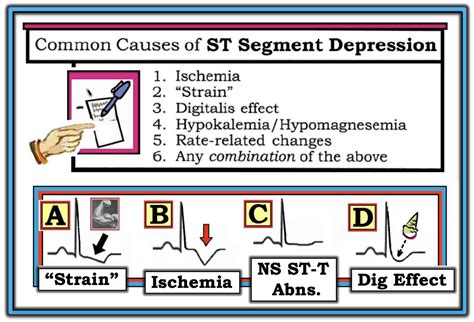 Dr. Smith's ECG Blog: Is this ST depression due to "lateral ischemia"?