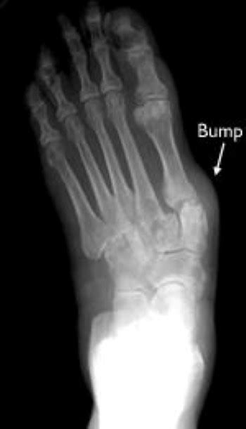 Rheumatoid Arthritis of the Foot and Ankle - OrthoInfo - AAOS