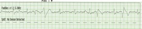 Float Nurse: ECG Rhythm Strips 86: Cardioversion of Atrial Flutter