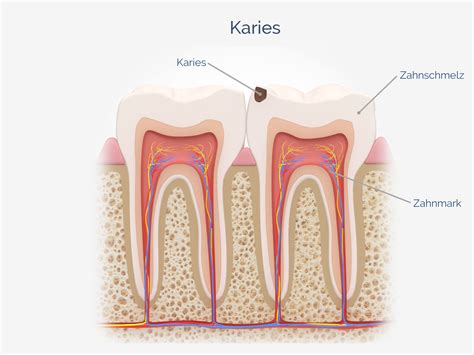 Karies Causes Symptoms Treatment Karies