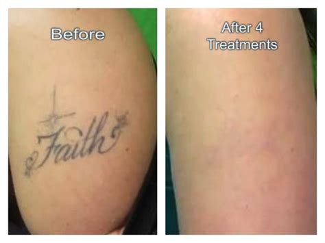 Permanent Laser Tattoo Removal in Dubai - Laser Skin Care Clinic