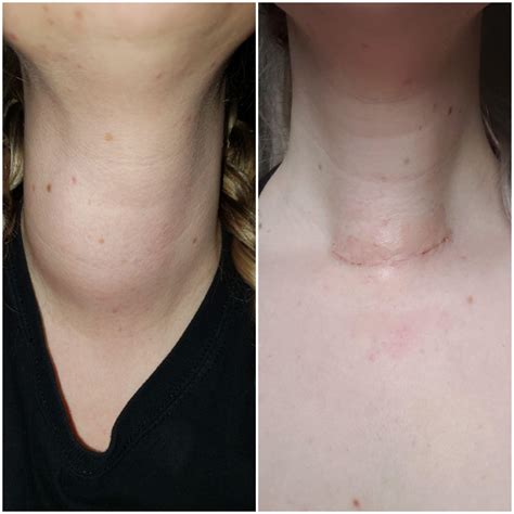 Pre thyroid lobectomy and 9 days post. : r/thyroidhealth