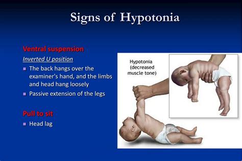 PPT - Hypotonia in Children PowerPoint Presentation, free download - ID:2750699