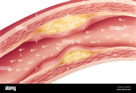 Vascular atherosclerosis showing a cutaway view of accumulated plaque in an afflicted blood ...