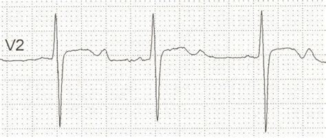 U Wave • LITFL Medical Blog • ECG Library Basics