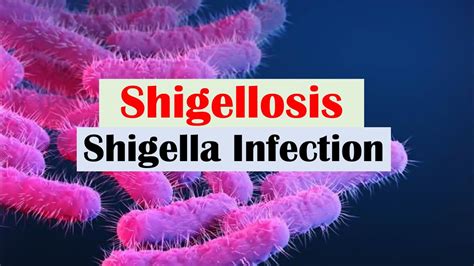 Shigellosis (Shigella) “A Cause of Bloody Diarrhea”: Pathophysiology ...