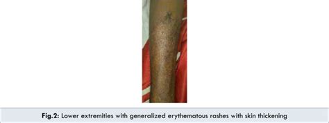 Dermatomyositis Presenting with Erythroderma