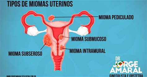 Tipos de Miomas Uterinos