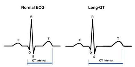 Long QT Syndrome Symptoms and Description of LQTS | AED Brands