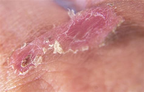 Macro Image Shows Second Degree Burn Wound Healing Stock Photo ...