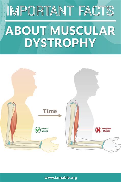 Important Facts About Muscular Dystrophy