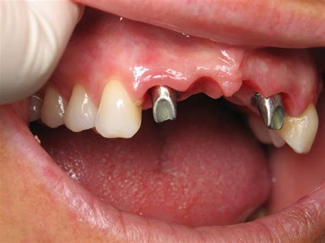 The Ovate Pontic – Ramsey Amin DDS of Burbank Explains This Dental Implant Bridge Detail ...