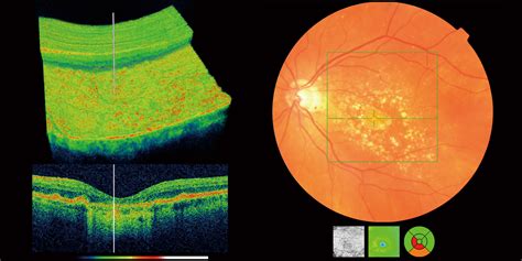 OCT Eye Scans are now available at Pybus Opticians - Pybus Opticians