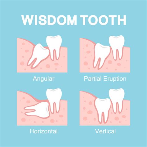 Wisdom Teeth Removal Cost Breakdown - Teeth Wisdom