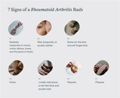 What Does A Rheumatoid Arthritis Rash Look Like? 7 Signs You Have RA