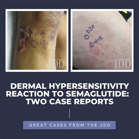 Dermal Hypersensitivity Reaction to Semaglutide: Two Case Reports - Next Steps in Dermatology