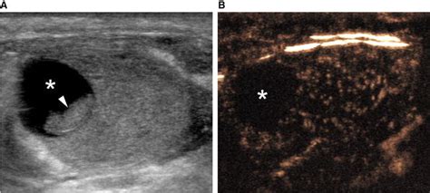 Testicular Cyst Ultrasound