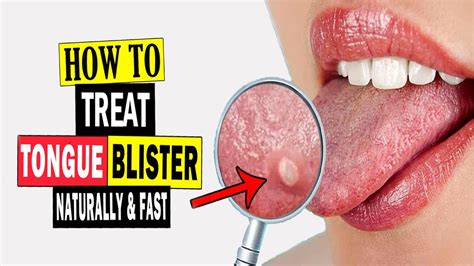 How to Treat Tongue Blisters Naturally || Home Remedies for Tongue Blisters Treatment - YouTube