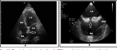 Figure 1 from Lipomatous Hypertrophy of the Interatrial Septum ...