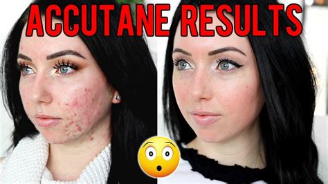 MY ACCUTANE JOURNEY 6 MONTH RESULTS Before & After, Side Effects, Would ...