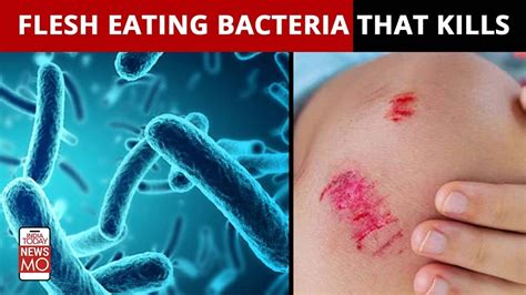 Necrotizing Fasciitis Bacteria Causes