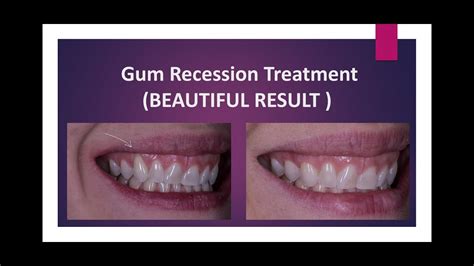 Gum recession treatment 😁 - YouTube