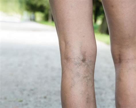 Understanding Spider Veins Laser Treatment